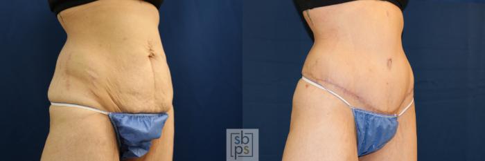Before & After Tummy Tuck Case 692 Right Oblique View in Torrance, CA