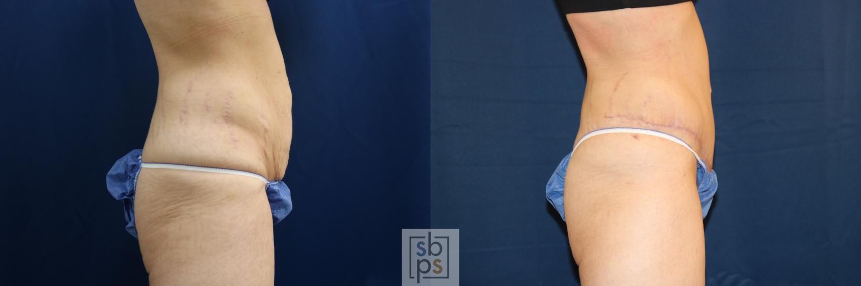 Before & After Tummy Tuck Case 692 Right Side View in Torrance & Los Angeles, CA, CA