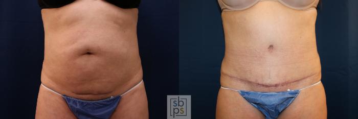 Before & After Tummy Tuck Case 702 Front View in Los Angeles & Torrance, CA, CA