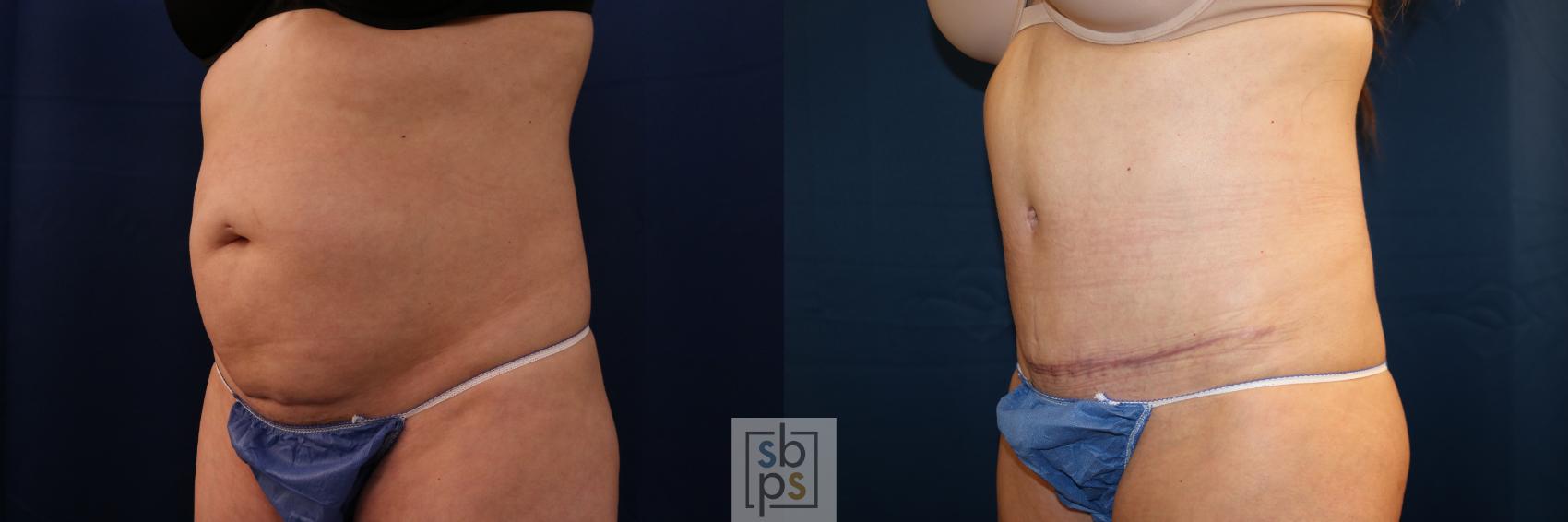 Before & After Tummy Tuck Case 702 Left Oblique View in Torrance & Los Angeles, CA, CA