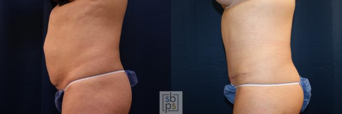 Before & After Tummy Tuck Case 702 Left Side View in Los Angeles & Torrance, CA, CA