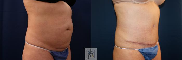 Before & After Tummy Tuck Case 702 Right Oblique View in Los Angeles & Torrance, CA, CA