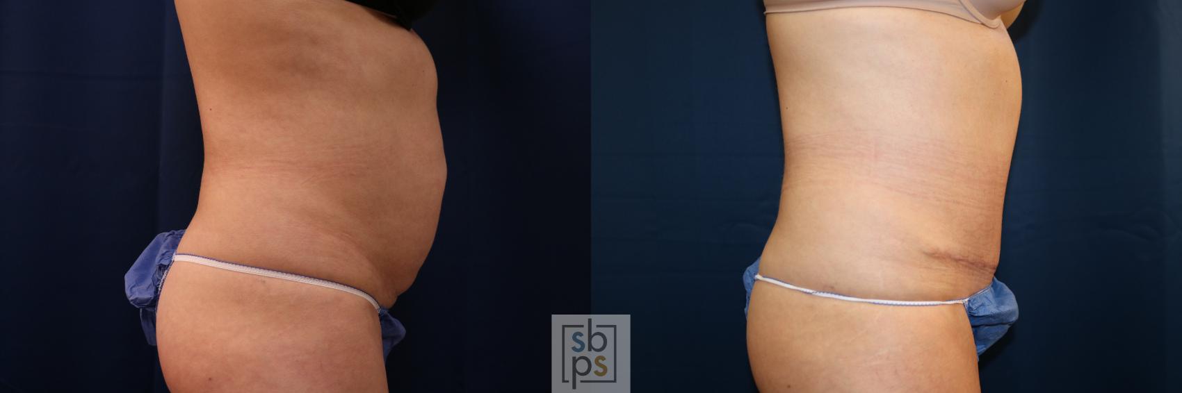 Before & After Tummy Tuck Case 702 Right Side View in Torrance & Los Angeles, CA, CA