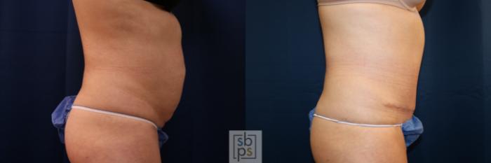 Before & After Tummy Tuck Case 702 Right Side View in Los Angeles & Torrance, CA, CA