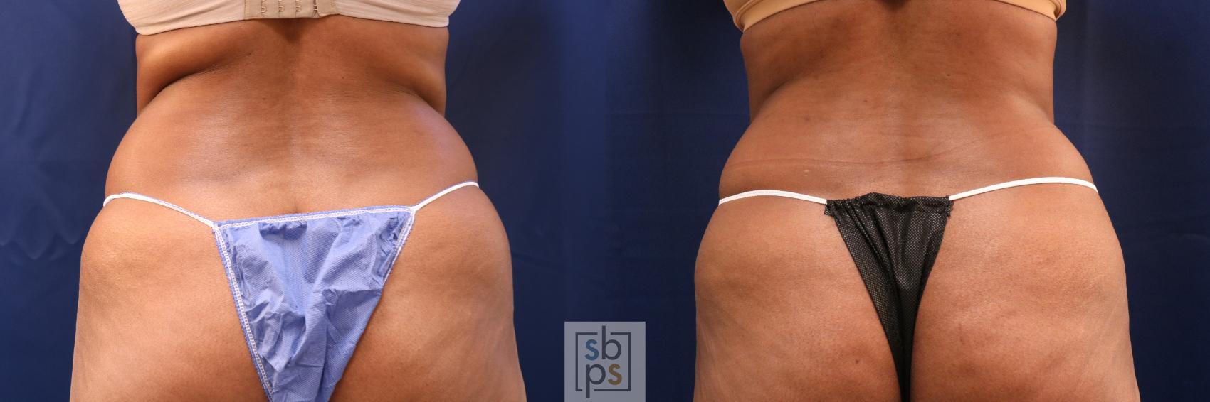Before & After Tummy Tuck Case 707 Back View in Torrance & Los Angeles, CA, CA