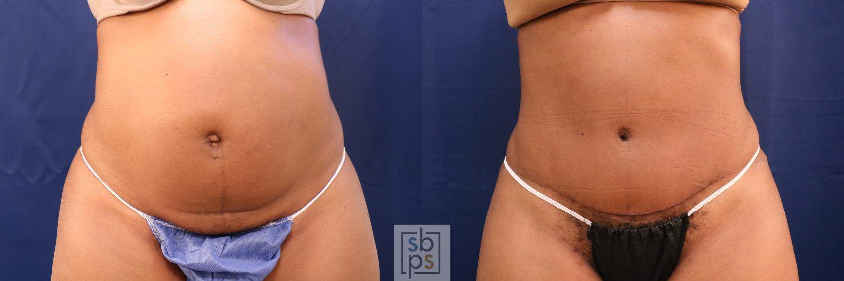 Before & After Tummy Tuck Case 707 Front View in Los Angeles & Torrance, CA, CA