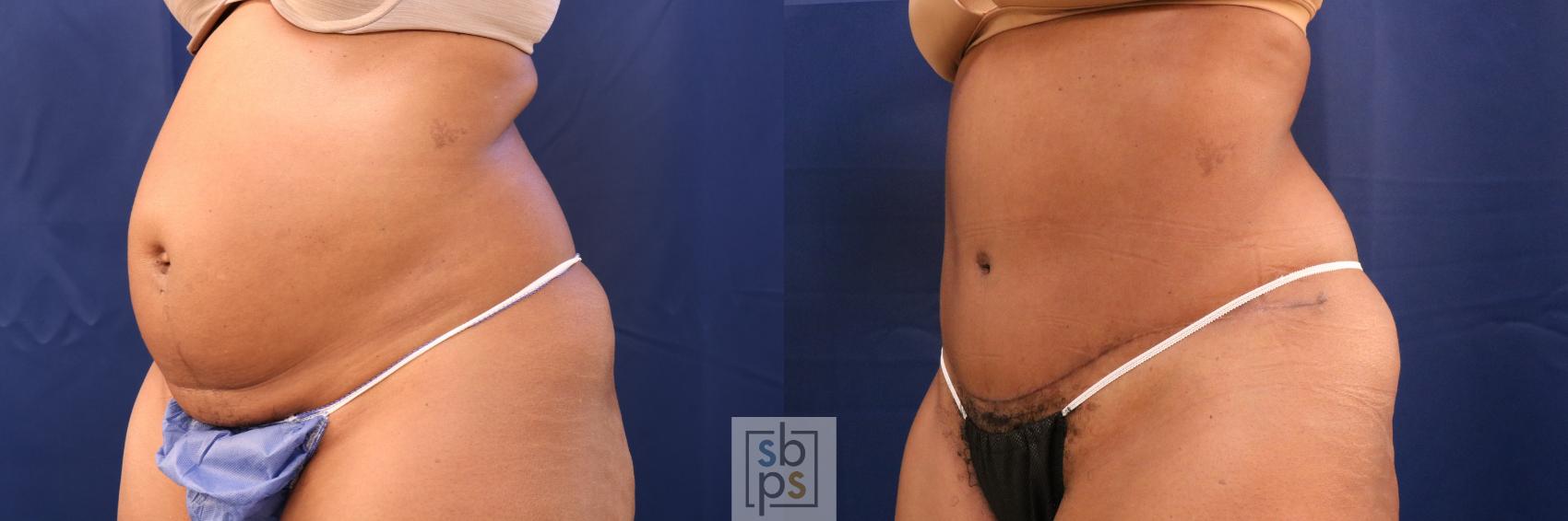 Before & After Tummy Tuck Case 707 Left Oblique View in Torrance & Los Angeles, CA, CA