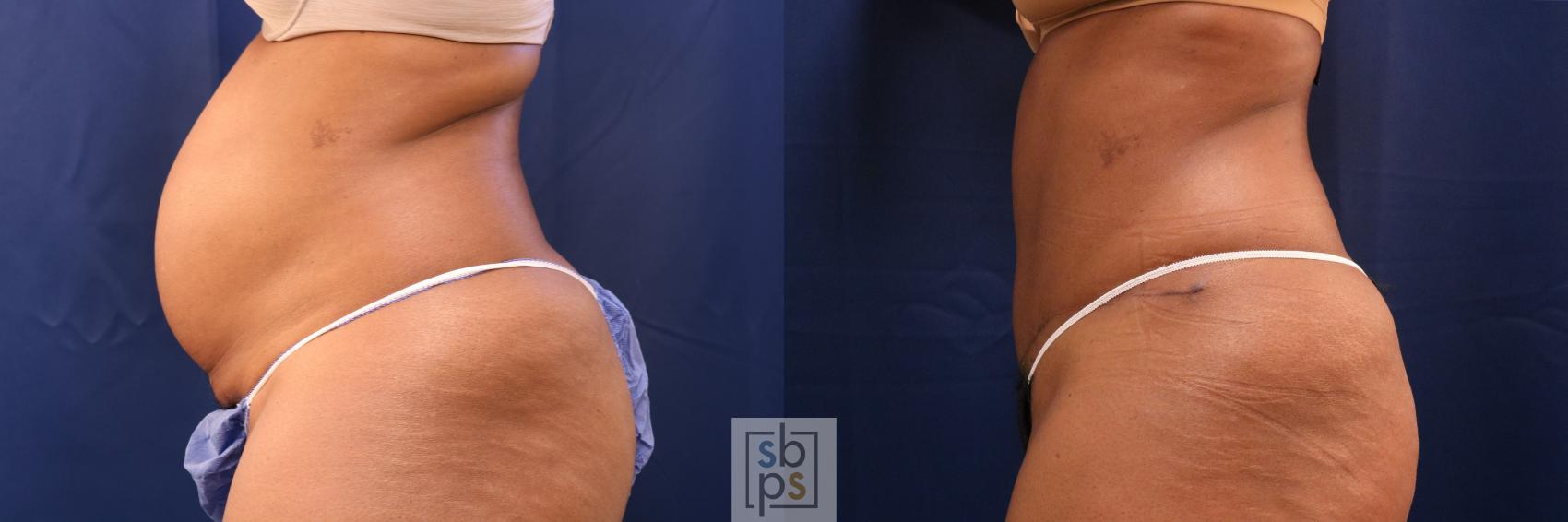 Before & After Tummy Tuck Case 707 Left Side View in Torrance & Los Angeles, CA, CA