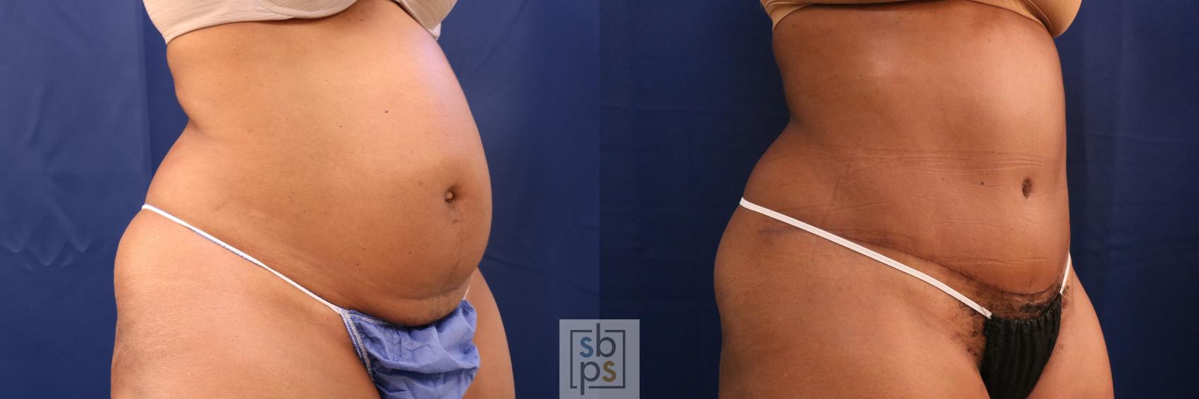 Before & After Tummy Tuck Case 707 Right Oblique View in Torrance & Los Angeles, CA, CA