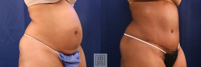 Before & After Tummy Tuck Case 707 Right Oblique View in Los Angeles & Torrance, CA, CA