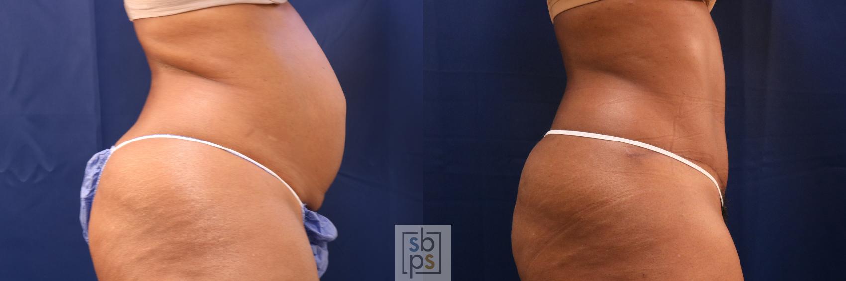 Before & After Tummy Tuck Case 707 Right Side View in Torrance & Los Angeles, CA, CA