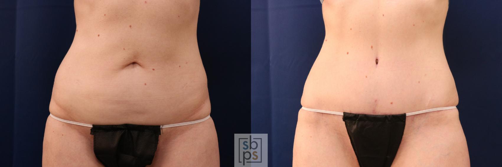 Before & After Tummy Tuck Case 713 Front View in Los Angeles & Torrance, CA, CA