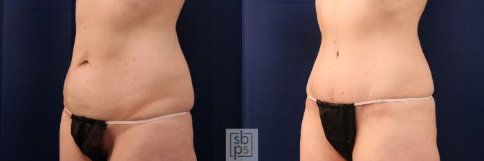 Before & After Tummy Tuck Case 713 Left Oblique View in Los Angeles & Torrance, CA, CA