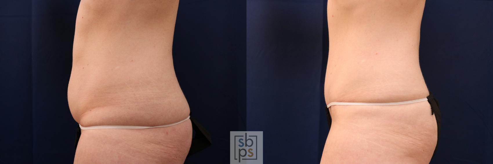 Before & After Tummy Tuck Case 713 Left Side View in Torrance & Los Angeles, CA, CA