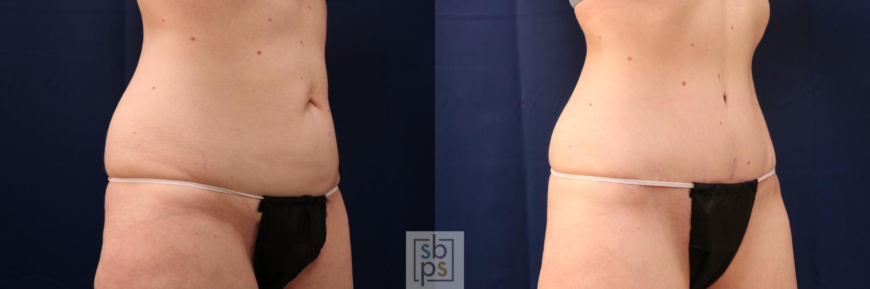Before & After Tummy Tuck Case 713 Right Oblique View in Torrance & Los Angeles, CA, CA
