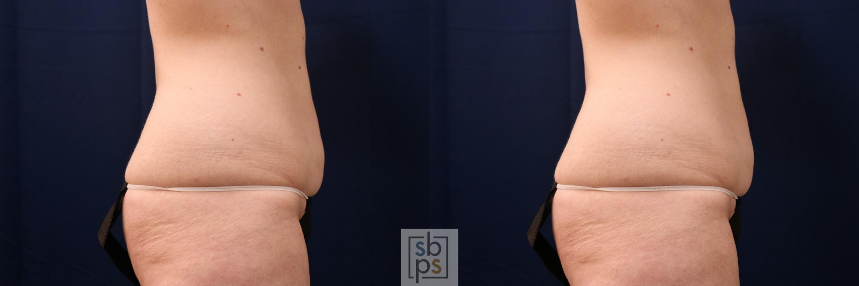 Before & After Tummy Tuck Case 713 Right Side View in Torrance & Los Angeles, CA, CA