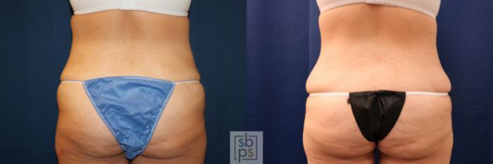 Before & After Tummy Tuck Case 716 Back View in Los Angeles & Torrance, CA, CA