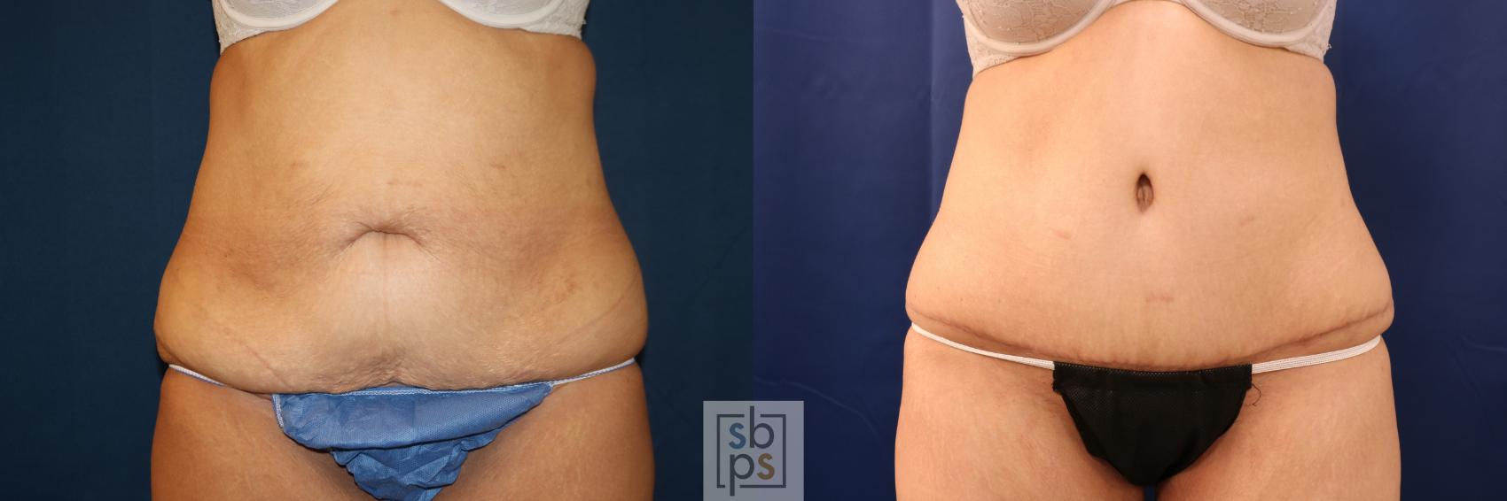 Before & After Tummy Tuck Case 716 Front View in Los Angeles & Torrance, CA, CA