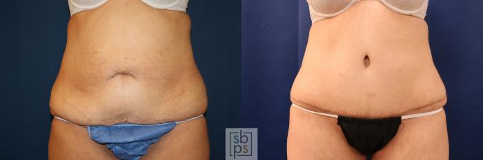 Before & After Tummy Tuck Case 716 Front View in Los Angeles & Torrance, CA, CA