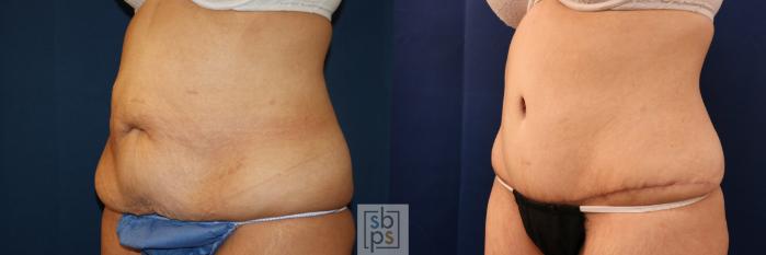 Before & After Tummy Tuck Case 716 Left Oblique View in Los Angeles & Torrance, CA, CA