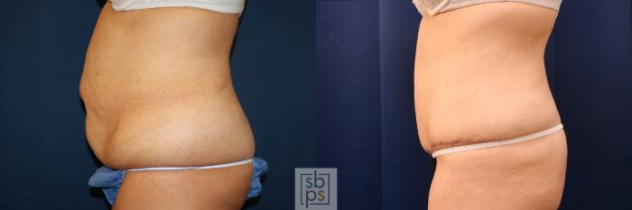 Before & After Tummy Tuck Case 716 Left Side View in Los Angeles & Torrance, CA, CA