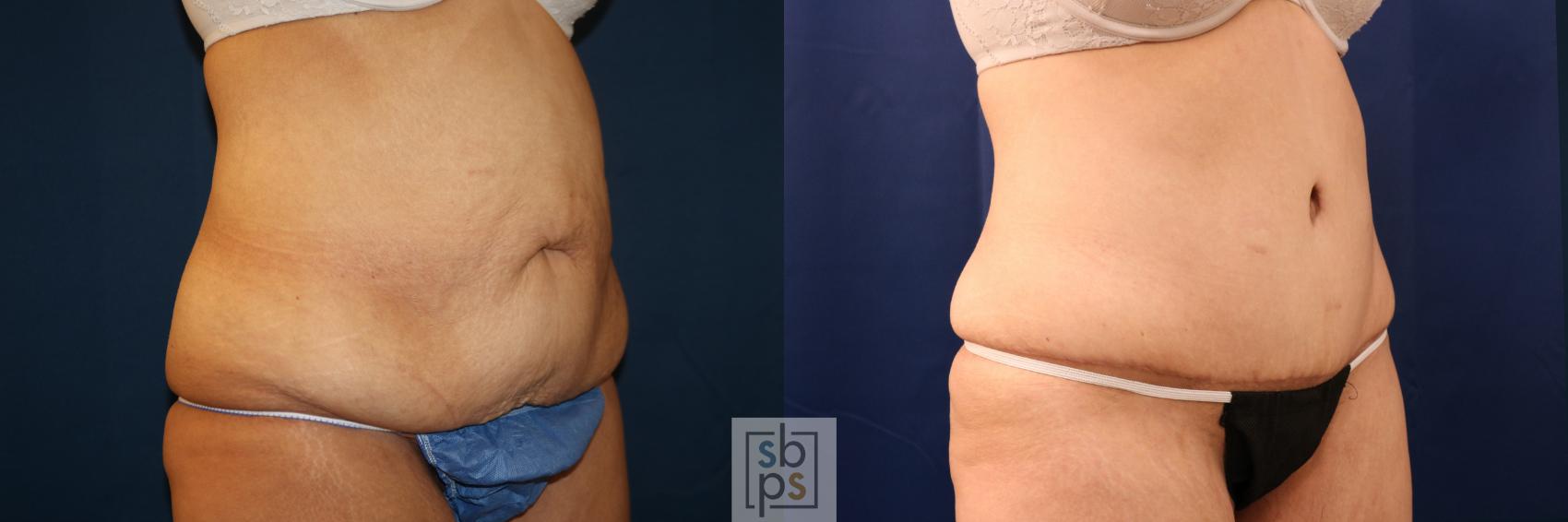 Before & After After Massive Weight Loss Case 716 Right Oblique View in Torrance & Los Angeles, CA, CA
