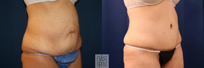 Before & After Tummy Tuck Case 716 Right Oblique View in Los Angeles & Torrance, CA, CA