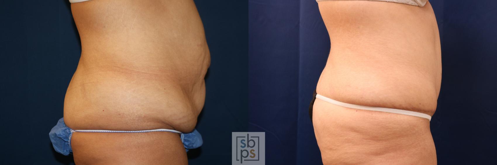 Before & After After Massive Weight Loss Case 716 Right Side View in Torrance & Los Angeles, CA, CA