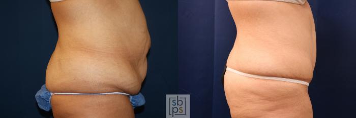 Before & After Tummy Tuck Case 716 Right Side View in Los Angeles & Torrance, CA, CA