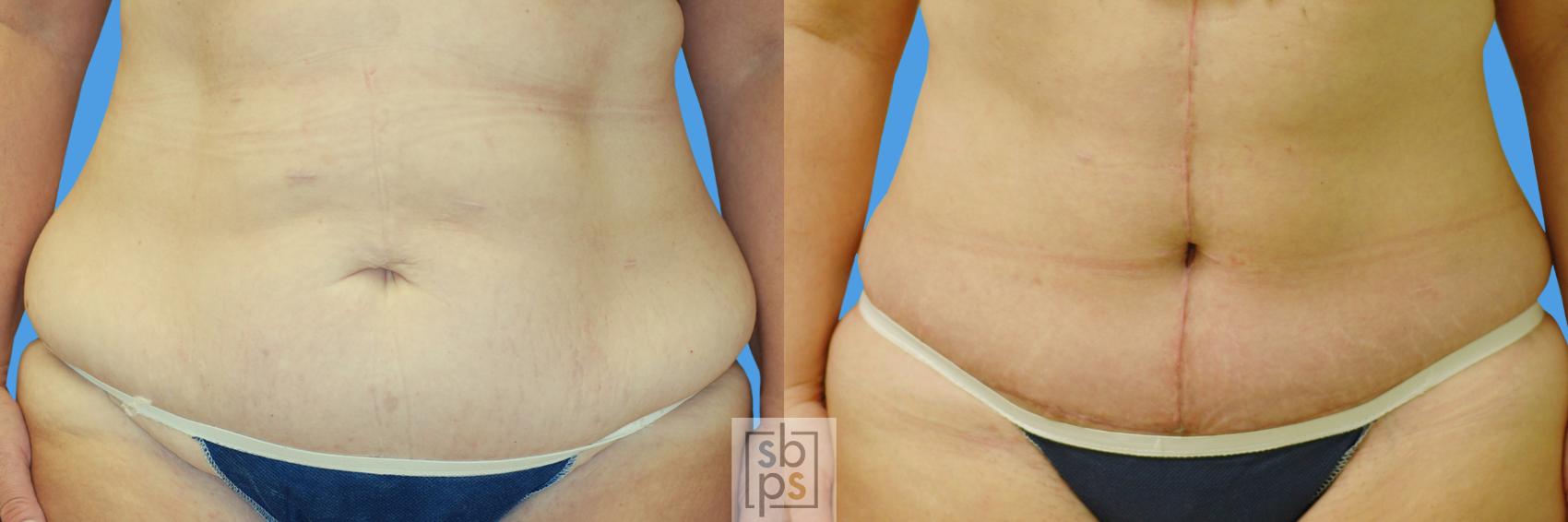 Before & After After Massive Weight Loss Case 72 View #1 View in Torrance, CA
