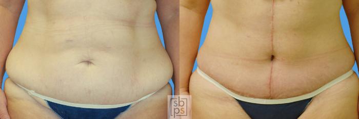 Before & After Tummy Tuck Case 72 View #1 View in Torrance, CA