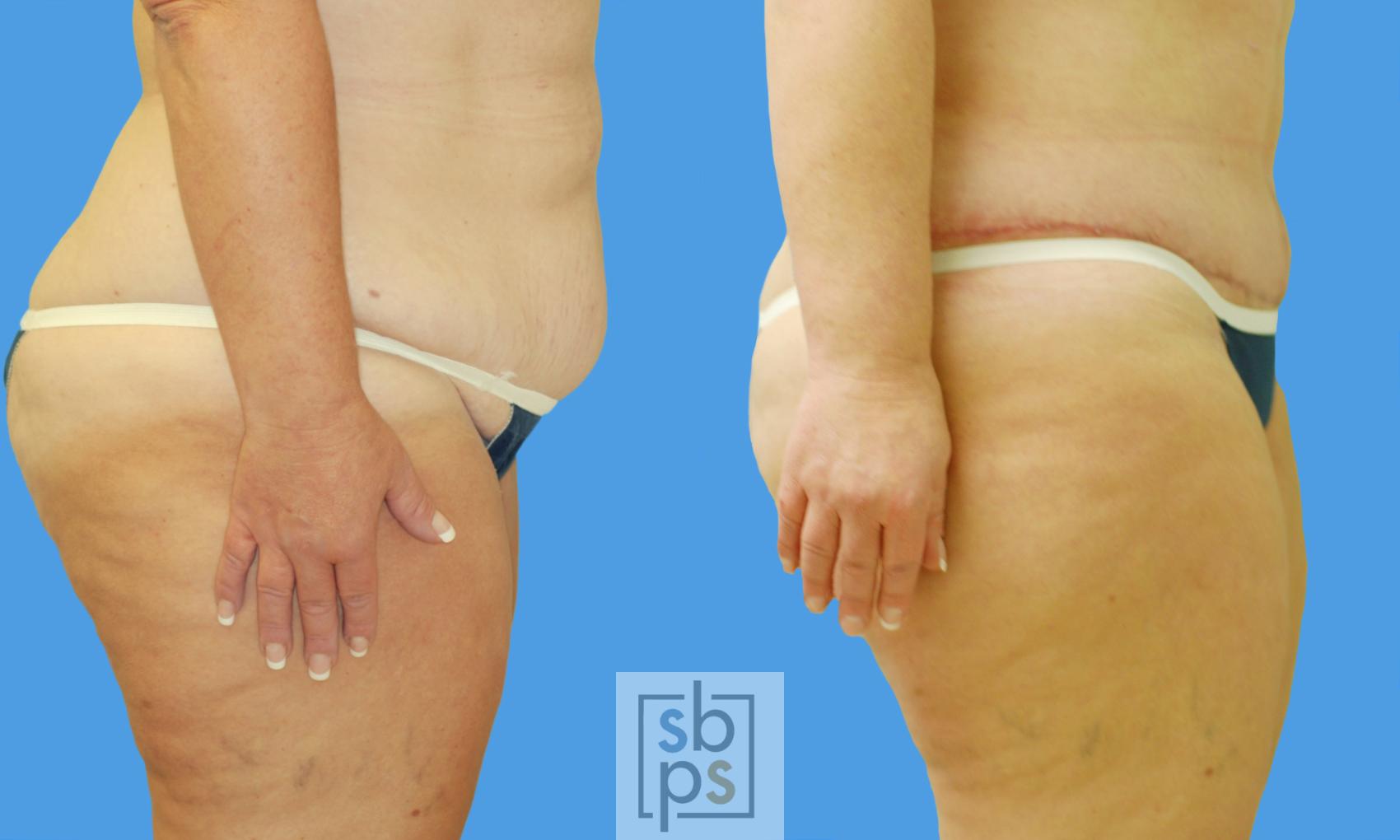 Before & After After Massive Weight Loss Case 72 View #2 View in Torrance, CA