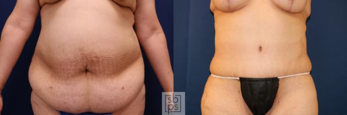 Before & After Tummy Tuck Case 721 Front View in Los Angeles & Torrance, CA, CA