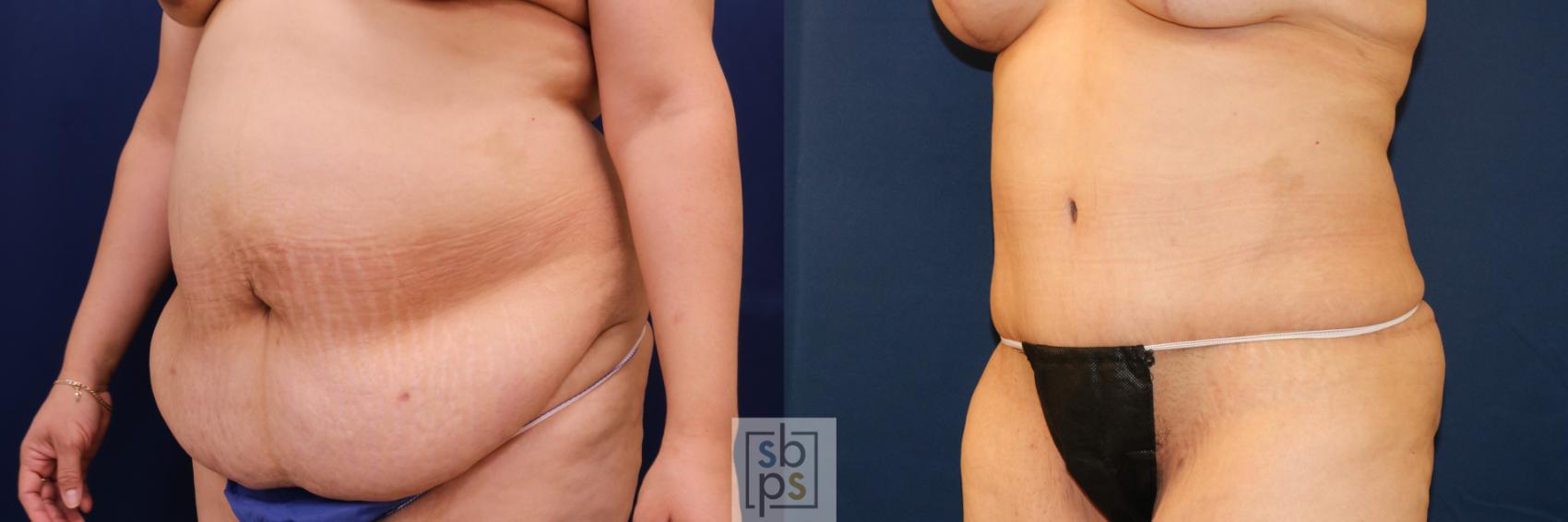 Before & After Tummy Tuck Case 721 Left Oblique View in Torrance & Los Angeles, CA, CA