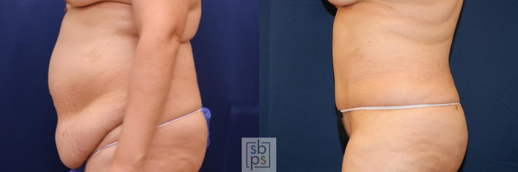 Before & After Tummy Tuck Case 721 Left Side View in Torrance & Los Angeles, CA, CA
