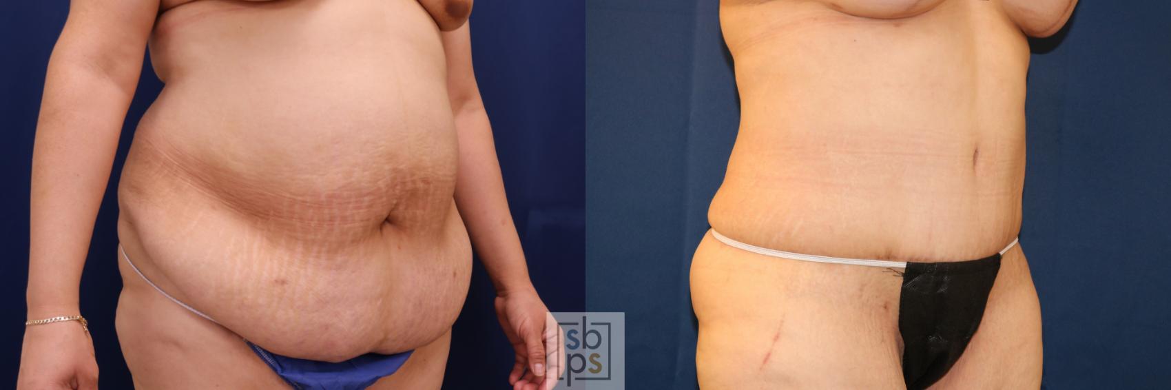Before & After Tummy Tuck Case 721 Right Oblique View in Torrance & Los Angeles, CA, CA