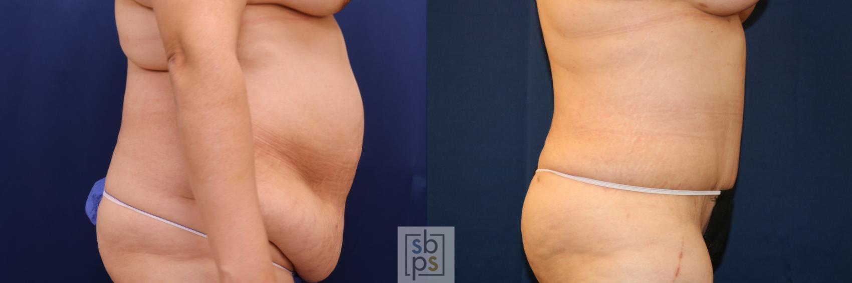 Before & After Tummy Tuck Case 721 Right Side View in Torrance & Los Angeles, CA, CA