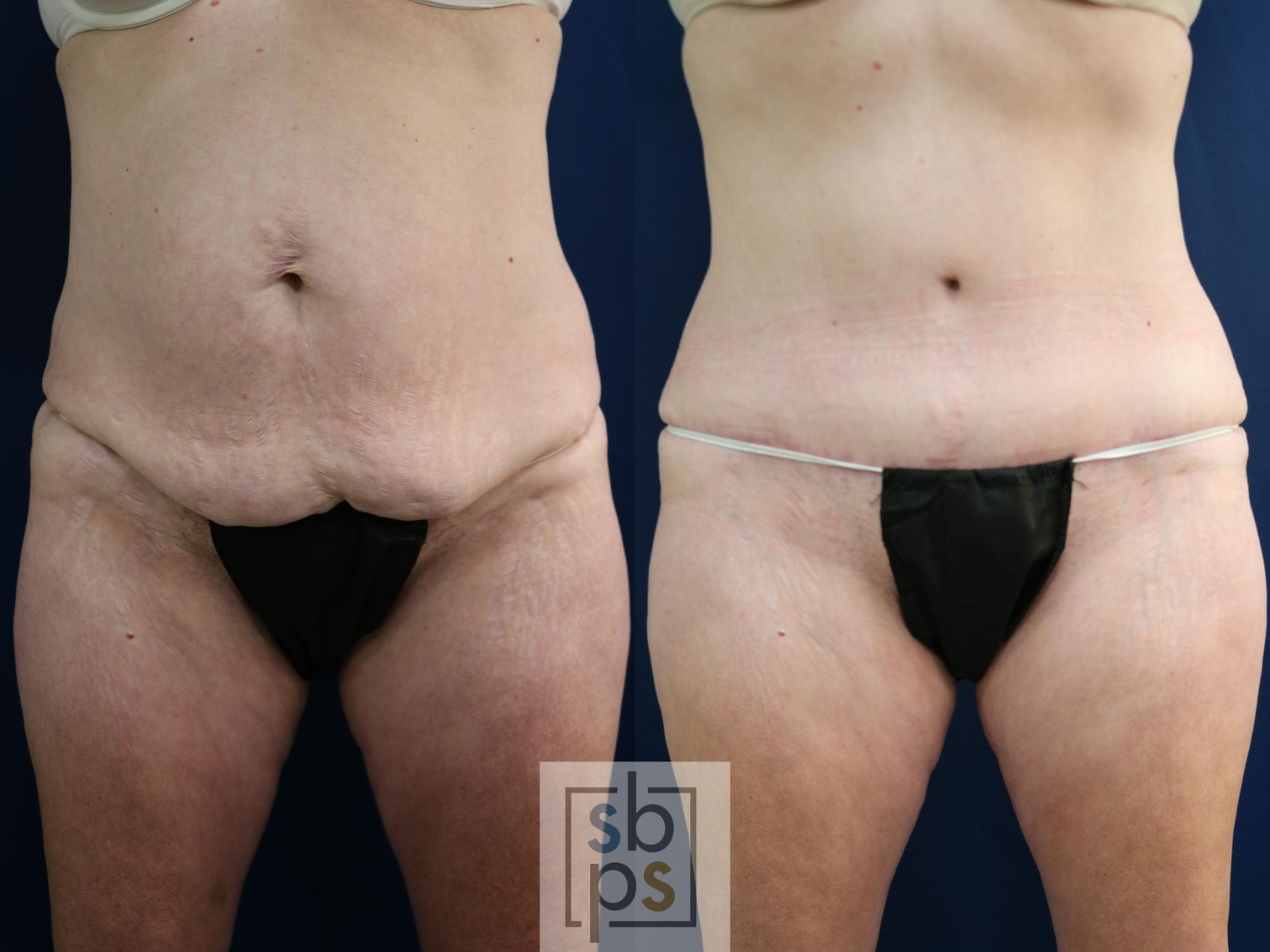 Before & After Tummy Tuck Case 750 Front View in Los Angeles, Torrance & Long Beach, CA