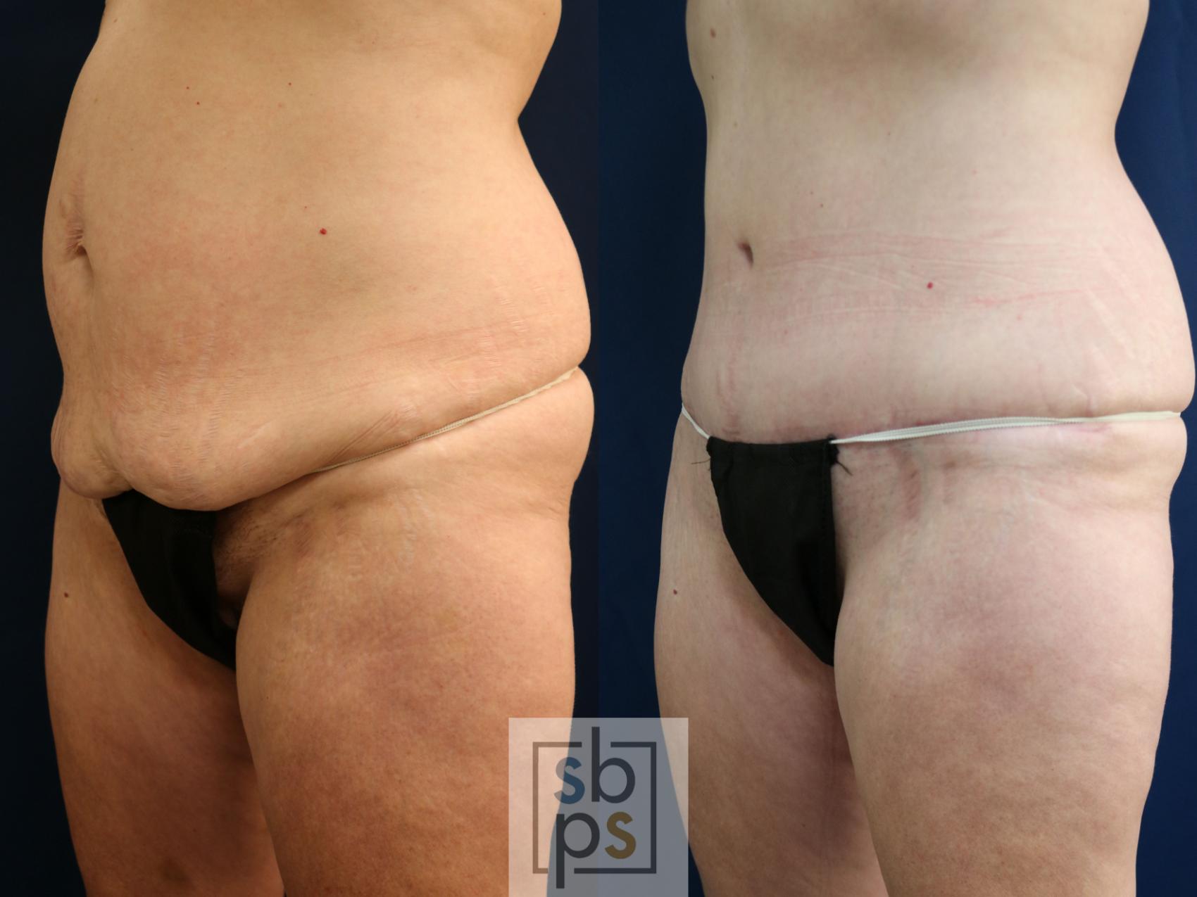 Before & After Tummy Tuck Case 750 Left Oblique View in Los Angeles, Torrance & Long Beach, CA
