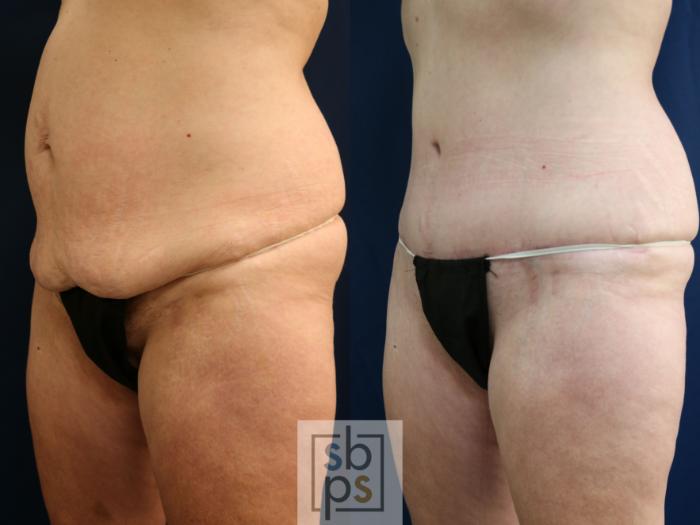Before & After Tummy Tuck Case 750 Left Oblique View in Los Angeles, Torrance & Long Beach, CA