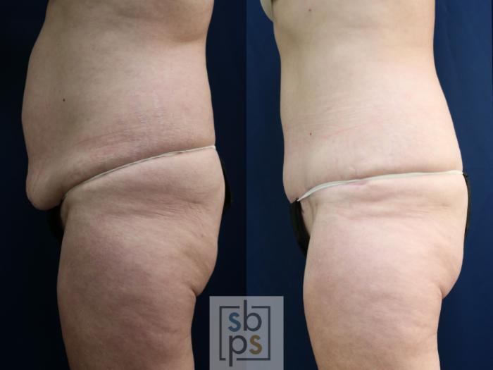 Before & After Tummy Tuck Case 750 Left Side View in Los Angeles, Torrance & Long Beach, CA