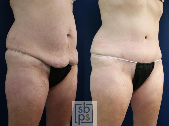 Before & After Tummy Tuck Case 750 Right Oblique View in Los Angeles, Torrance & Long Beach, CA