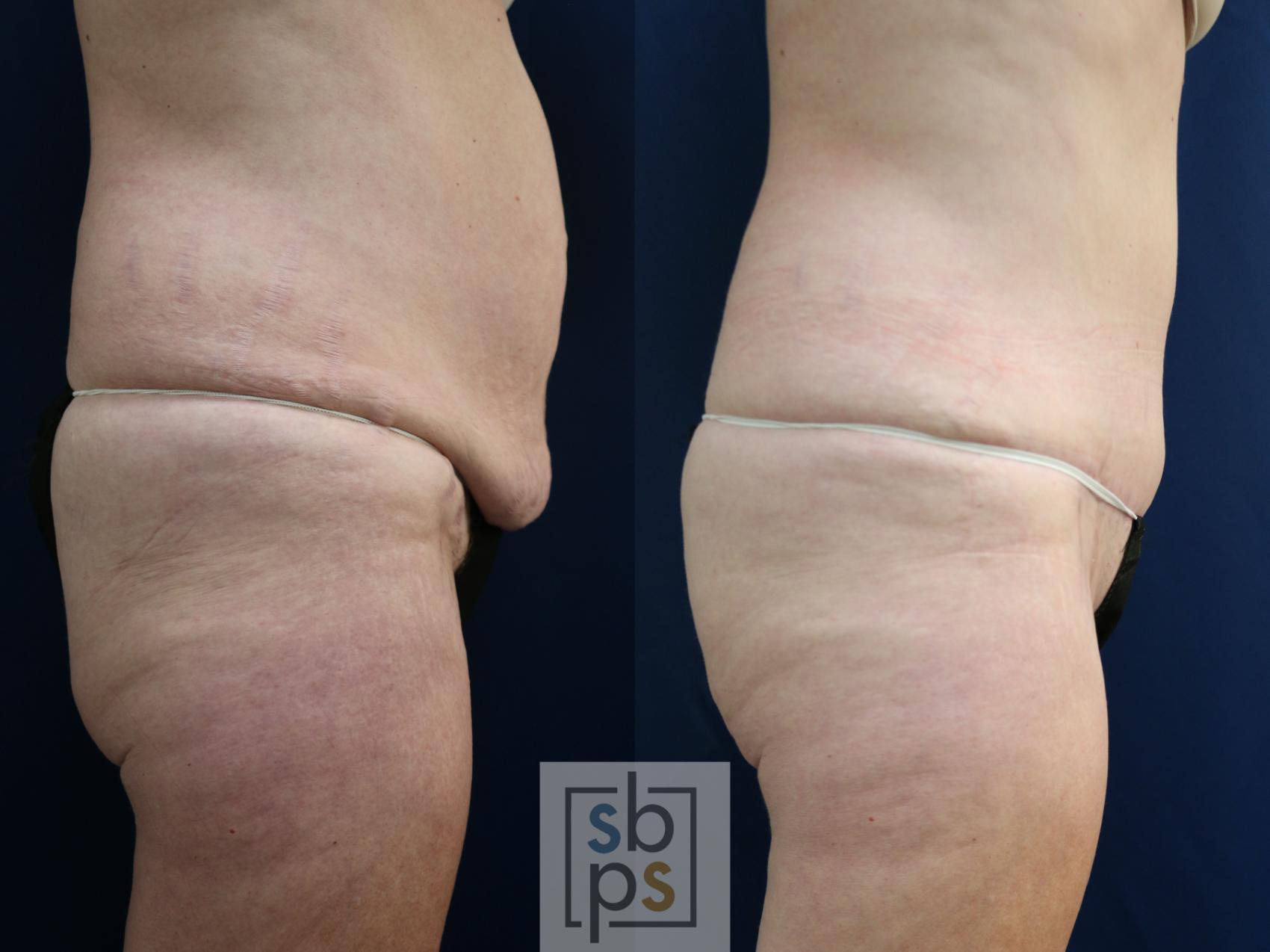 Before & After Tummy Tuck Case 750 Right Side View in Los Angeles, Torrance & Long Beach, CA