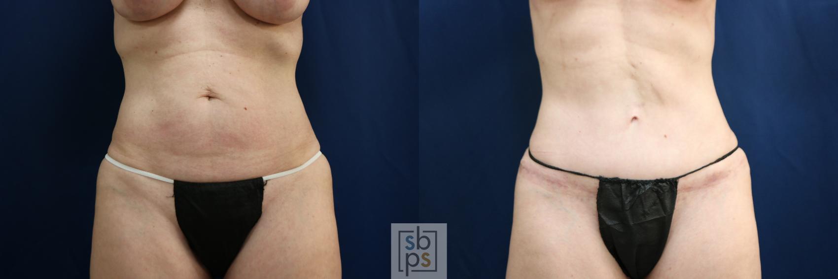 Before & After Tummy Tuck Case 751 Front View in Los Angeles, Torrance & Long Beach, CA