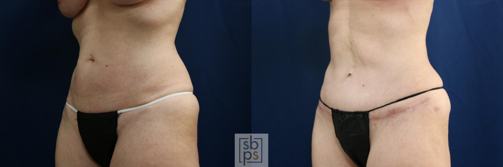 Before & After Tummy Tuck Case 751 Left Oblique View in Los Angeles, Torrance & Long Beach, CA