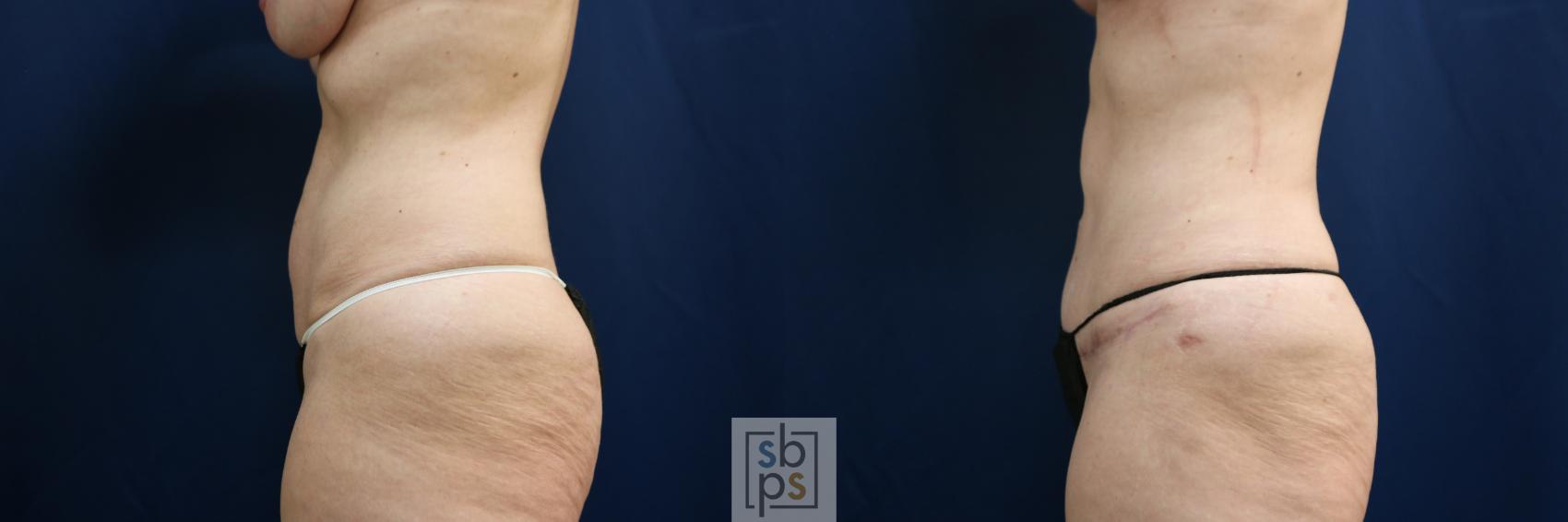 Before & After Tummy Tuck Case 751 Left Side View in Los Angeles, Torrance & Long Beach, CA