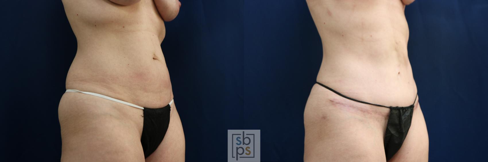 Before & After Tummy Tuck Case 751 Right Oblique View in Los Angeles, Torrance & Long Beach, CA