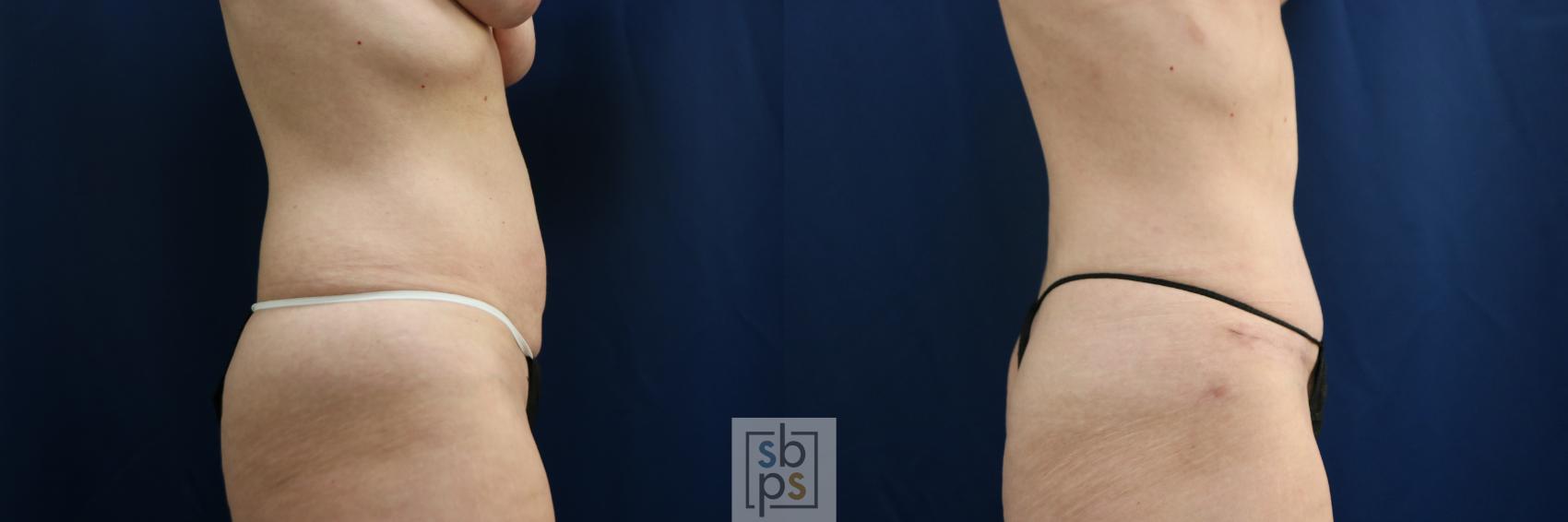 Before & After Tummy Tuck Case 751 Right Side View in Los Angeles, Torrance & Long Beach, CA