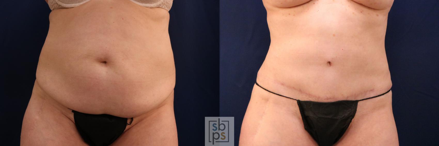 Before & After Tummy Tuck Case 753 Front View in Los Angeles, Torrance & Long Beach, CA