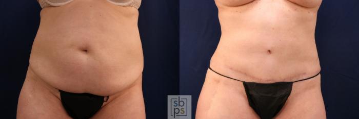 Before & After Tummy Tuck Case 753 Front View in Los Angeles, Torrance & Long Beach, CA
